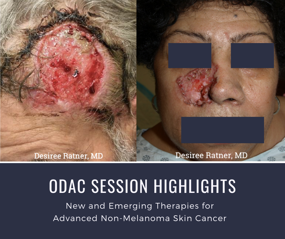 Advanced non-melanoma skin cancer patient image