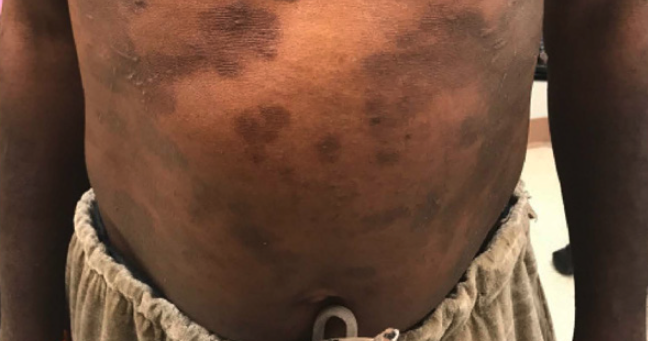 atopic dermatitis two weeks following initiation of dupilumab.