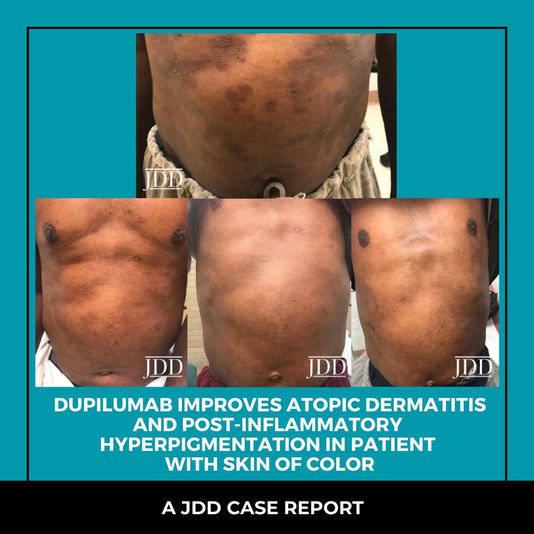 Dupilumab Improves Atopic Dermatitis And Post Inflammatory