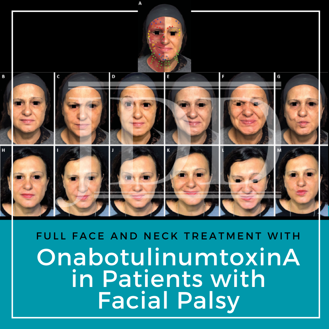 Full Face and Neck Treatment With OnabotulinumtoxinA in Patients With Facial Palsy
