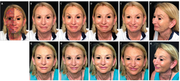 onabotulinumtoxinA in a patient with facial palsy