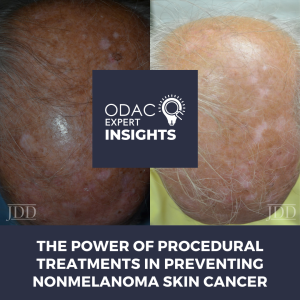 procedural treatments to prevent non-melanoma skin cancer
