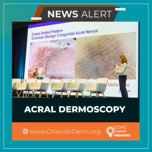 acral dermoscopy