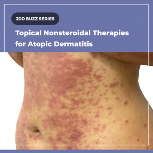 topical nonsteroidal therapies